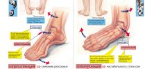 Виды деформаций стоп