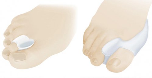 Корректоры стопы